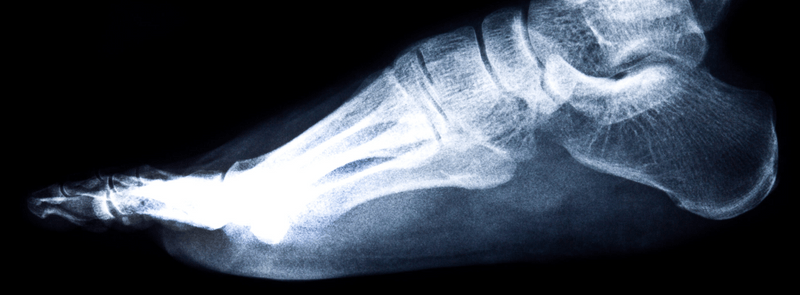 O que é uma radiografia do pé e o que ela diagnostica? - Eva